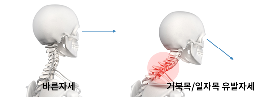 일자목/거북목이란?