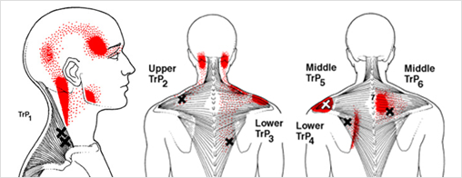 근막통증증후군이란?
