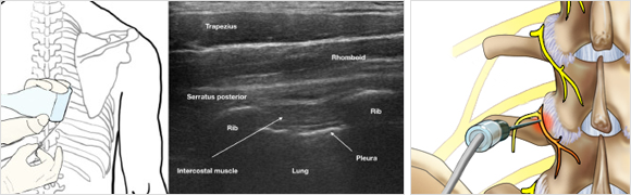 신경차단술이란?