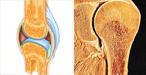 관절강 내 주사치료란?