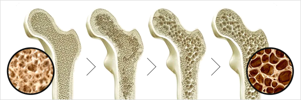 골다공증이란?